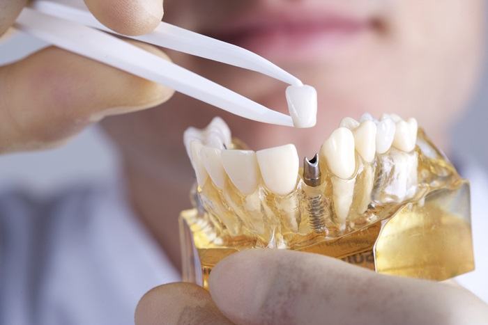 5 bước trong quy trình trồng răng implant chuẩn 1 5 bước trong quy trình trồng răng implant