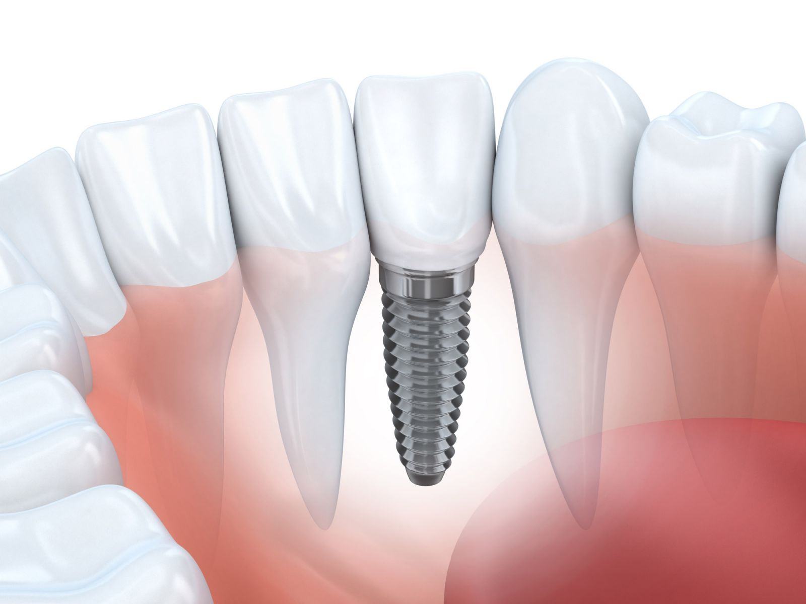 5 điều cần biết về trồng răng implant 1 Vietsmile trong rang implant