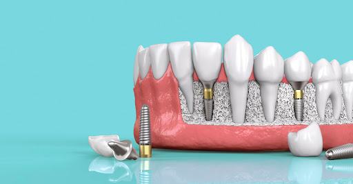 5 thông tin quan trọng về răng implant 1 5 thông tin quan trọng về implant nha khoa