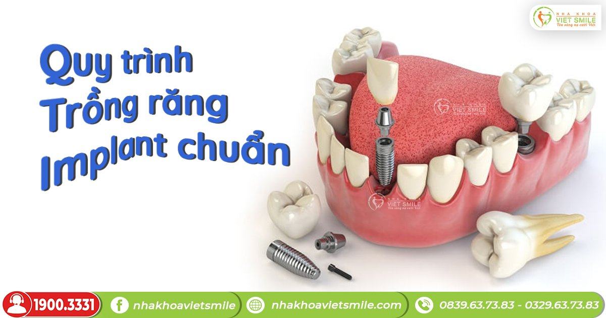Quy trình trồng răng implant chuẩn