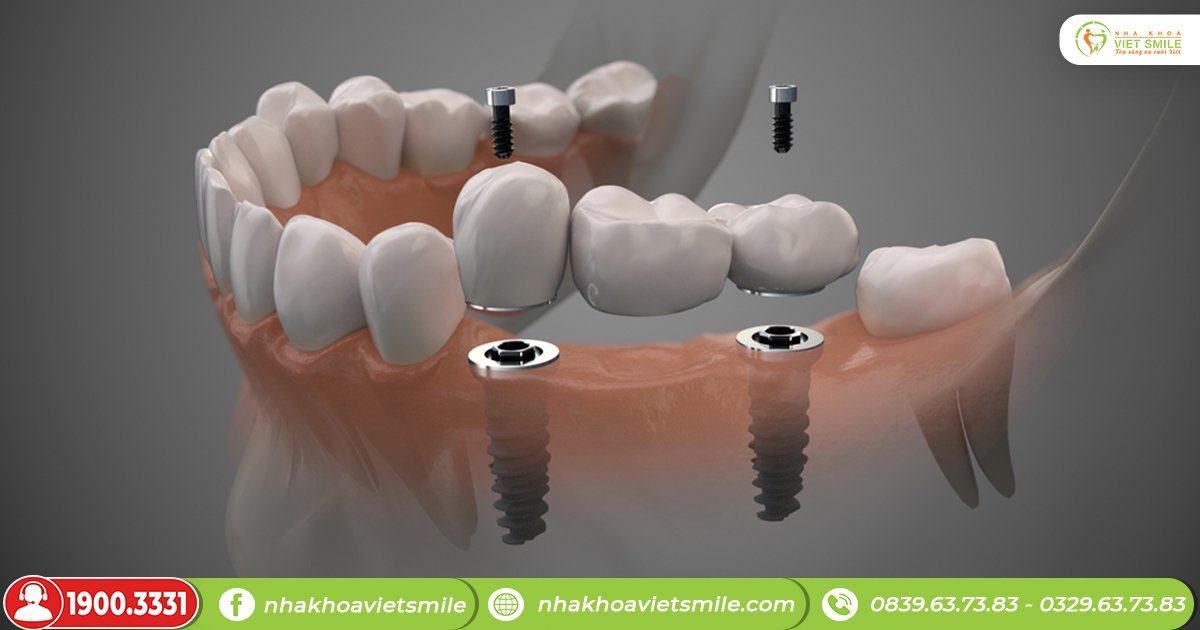 Trồng răng implant, ngăn chặn nguy cơ tiêu xương hàm