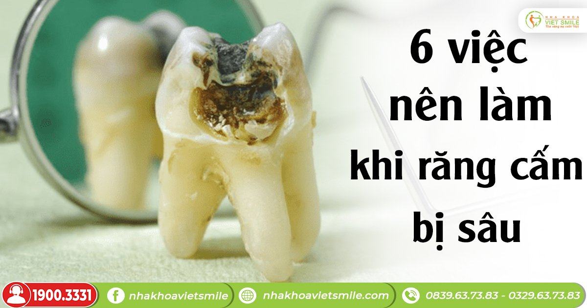 6 việc nên làm khi bị đau răng cấm