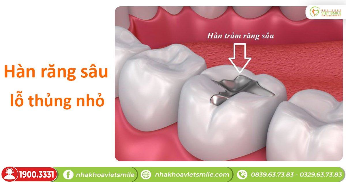 Hàn răng khi sâu răng hàm
