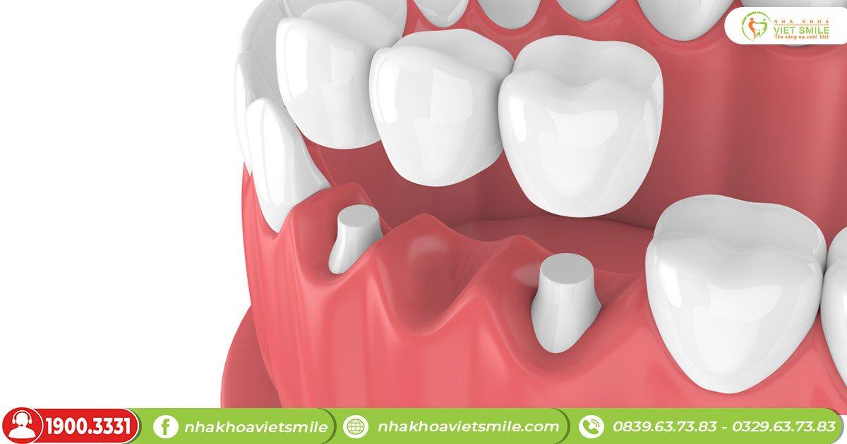 Làm bắc cầu răng khắc phục tình trạng gãy răng cửa