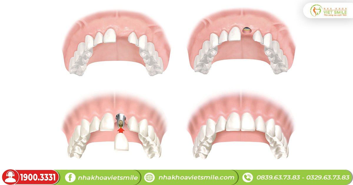 Trồng răng implant khắc phục tình trạng gãy răng cửa