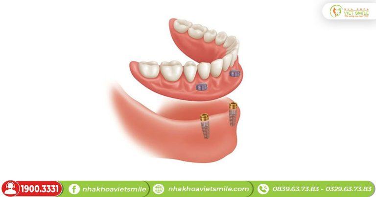 Hàm răng giả tháo lắp giá bao nhiêu? 4 loại hàm phổ biến