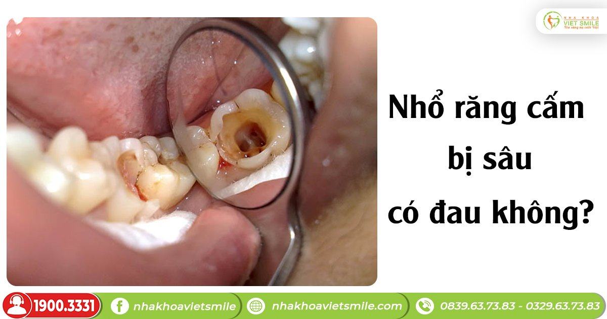 Nhổ răng cấm bị sâu có đau không?