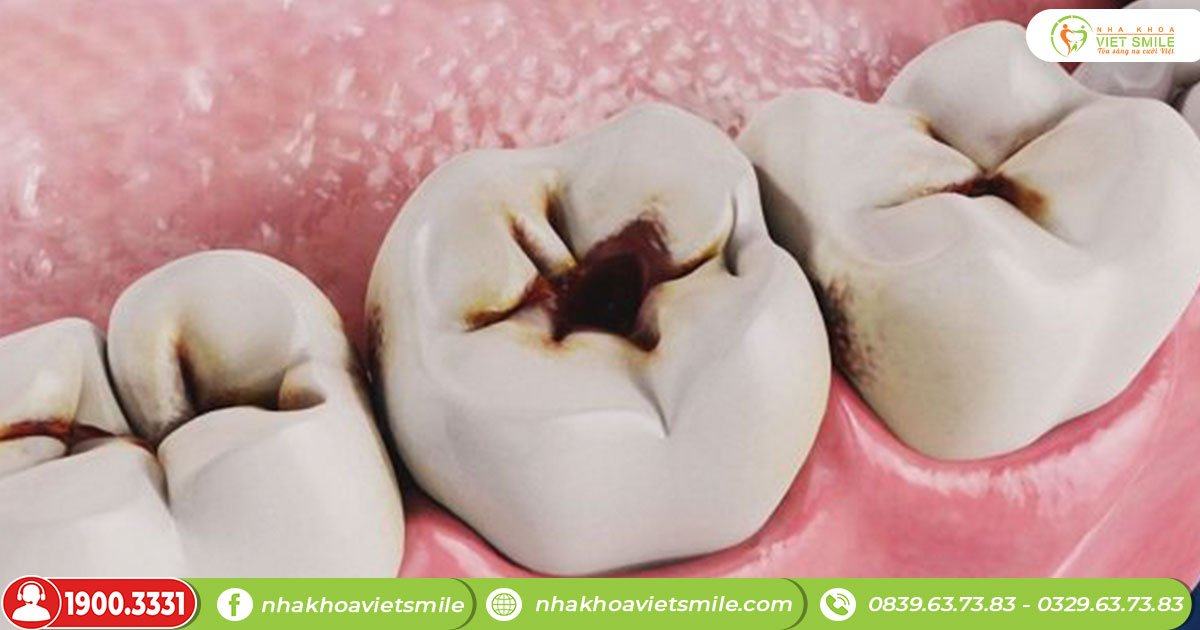 Răng bị sâu và làm răng hàm lung lay có nên nhổ không?