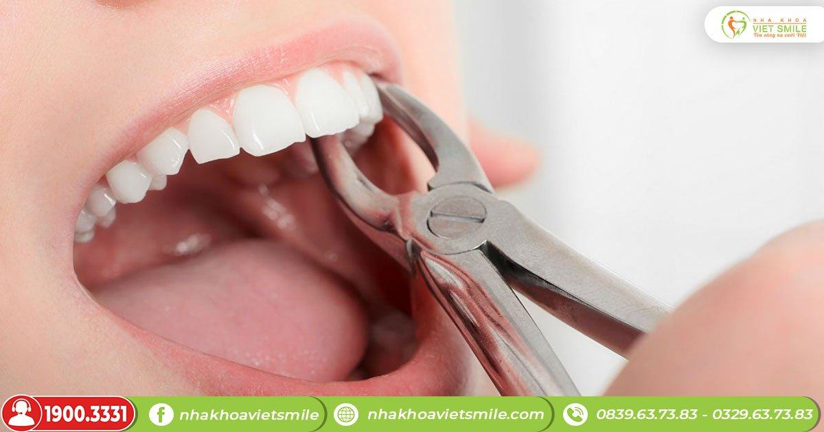 Răng bị nhức và làm răng hàm lung lay có nên nhổ không?