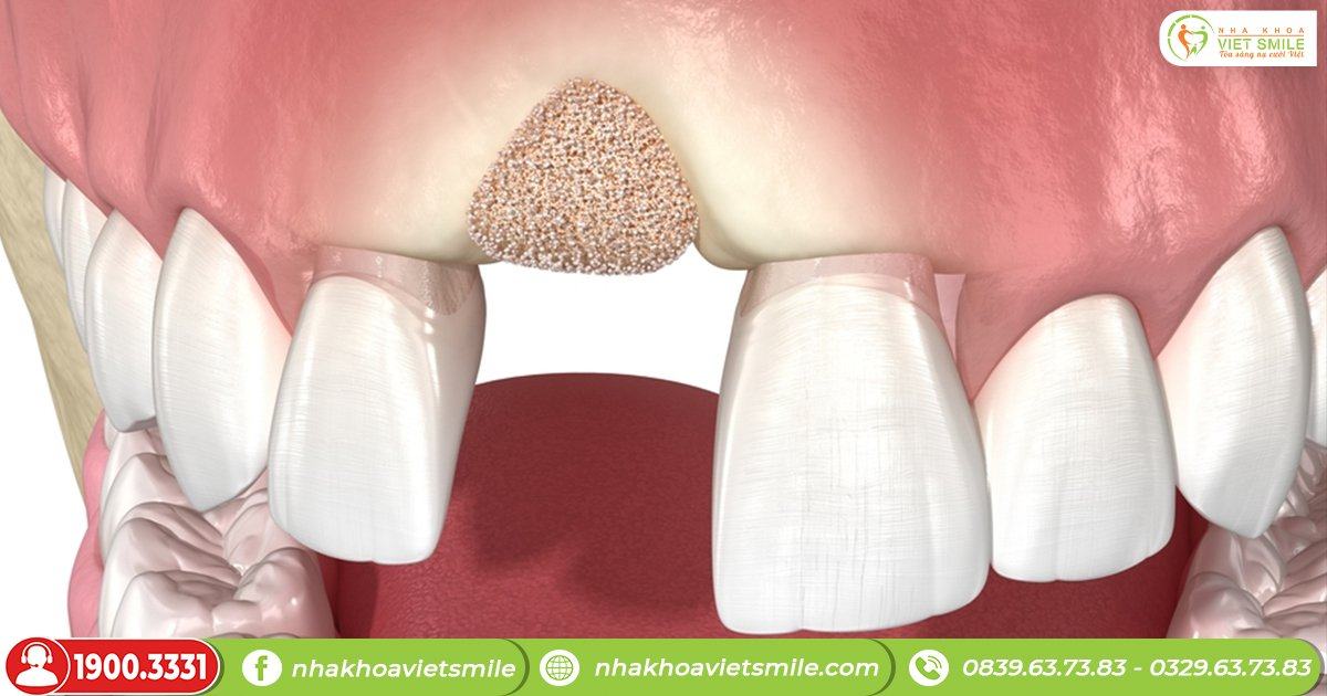 Ghép xương răng là gì?