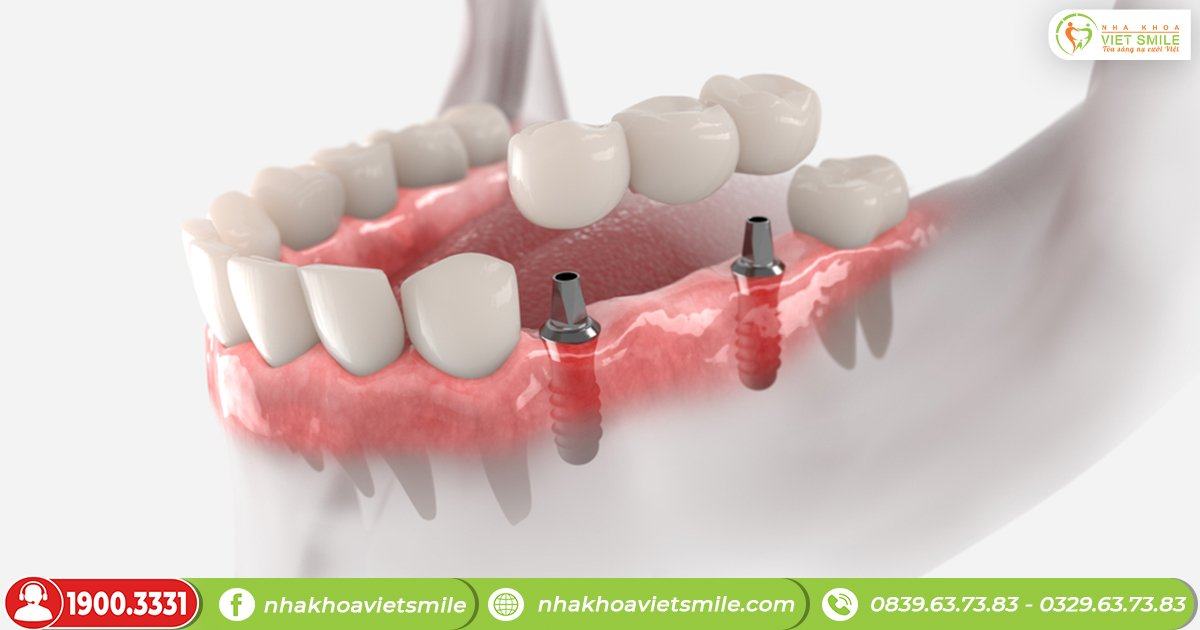 Ghép xương răng bao lâu thì lành? 5 Ghép xương giúp đảm bảo quá trình cấy ghép implant thuận lợi