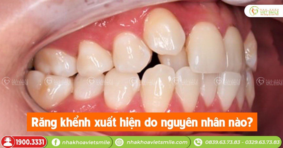 Răng khểnh xuất hiện do nguyên nhân nào?