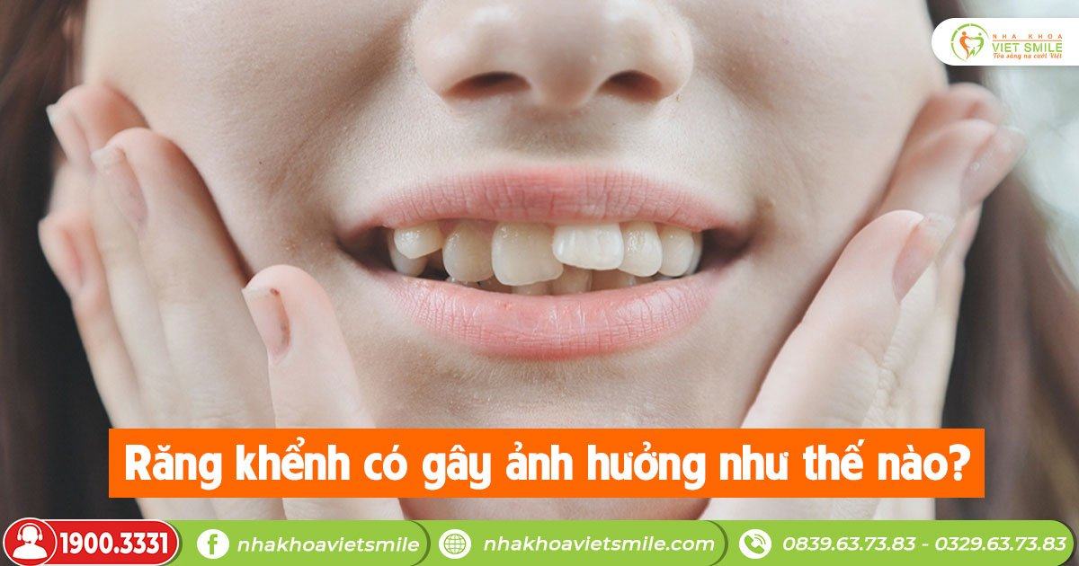 Răng khểnh gây ảnh hưởng gì không?