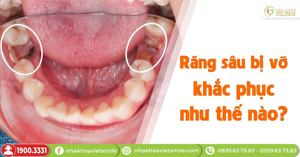 Răng sâu bị vỡ khắc phục như thế nào?