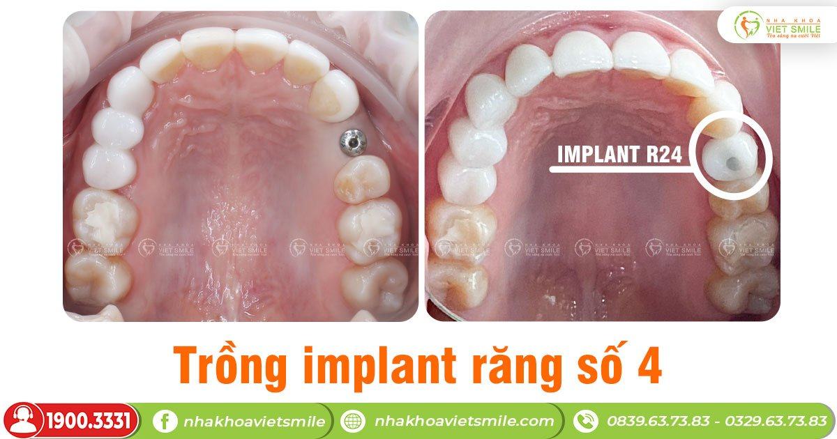 Trồng răng implant khi mất răng số 4