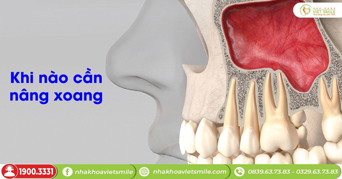 Nâng xoang kín và nâng xoang hở trong cấy ghép implant 2 Cấy ghép implant cần nâng xoang khi nào?