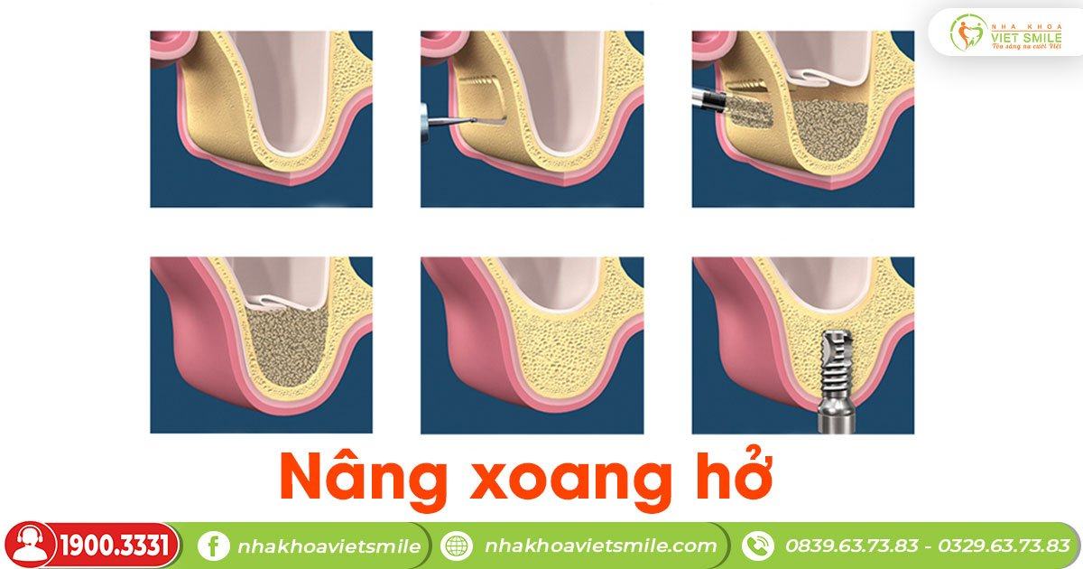 Nâng xoang kín và nâng xoang hở trong cấy ghép implant 3 Kỹ thuật nâng xoang hở