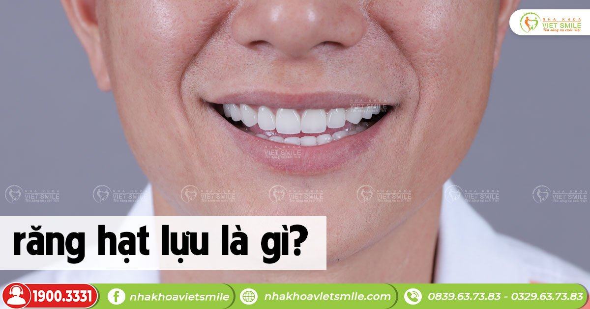 Răng hạt lựu là gì?