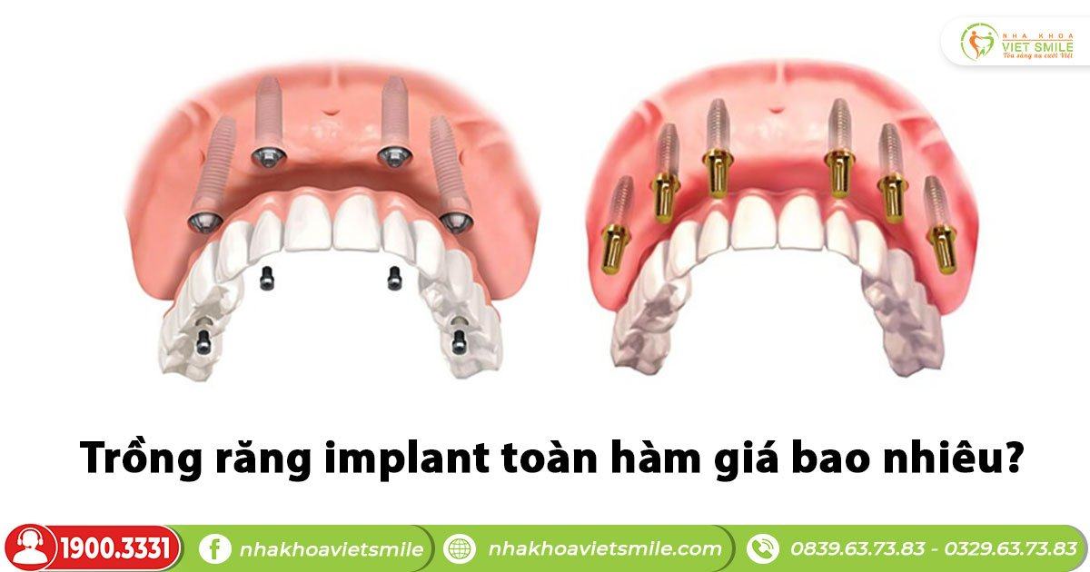 Trồng răng implant toàn hàm giá bao nhiêu?