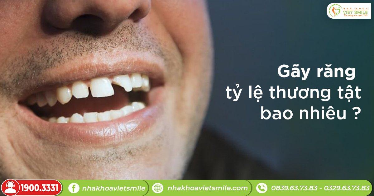 Gãy răng thương tích bao nhiêu phần trăm?