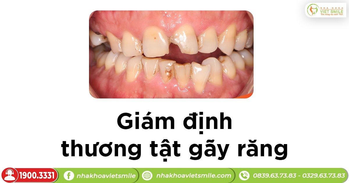 Giám định thương tật gãy răng