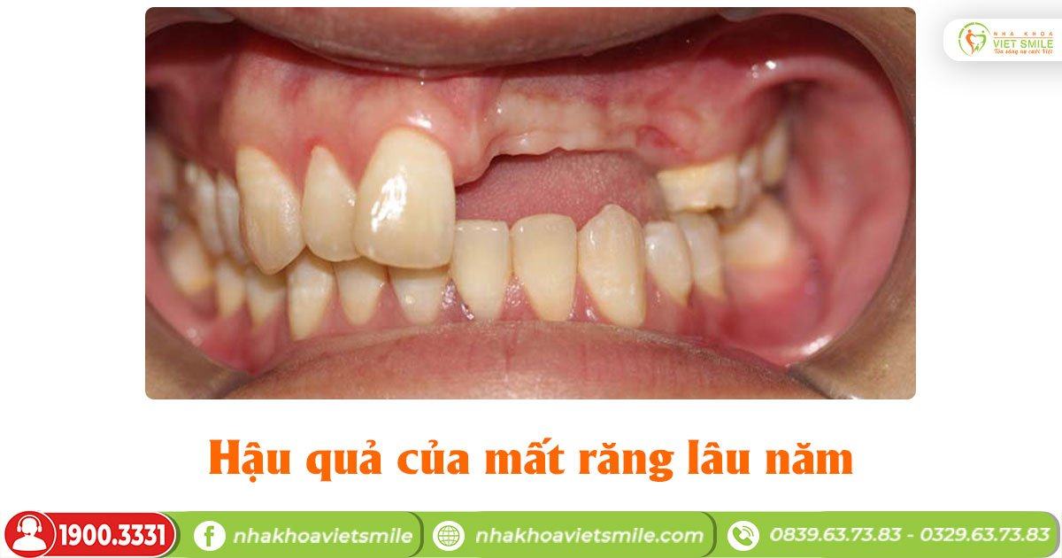 Hậu quả của mất răng lâu năm