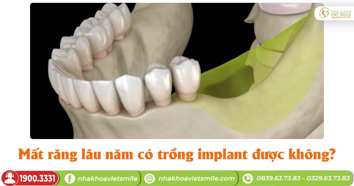 Mất răng lâu năm có trồng implant được không?