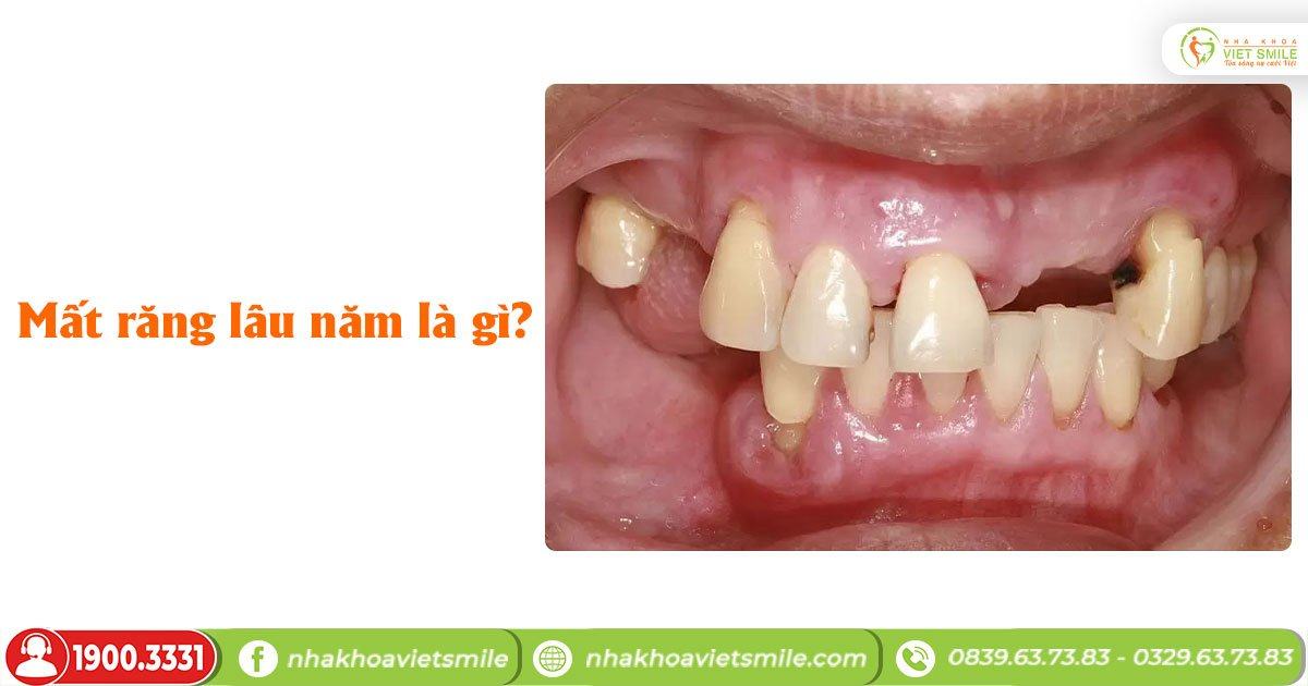Mất răng lâu năm là gì?