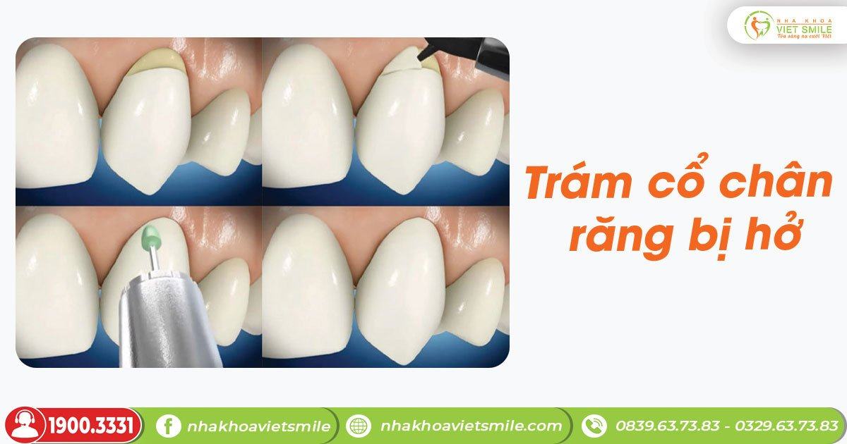 Trám răng composite cho răng bị mòn