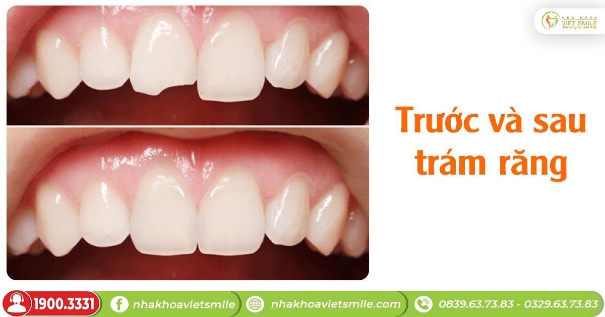 Trám răng composite cho răng mẻ