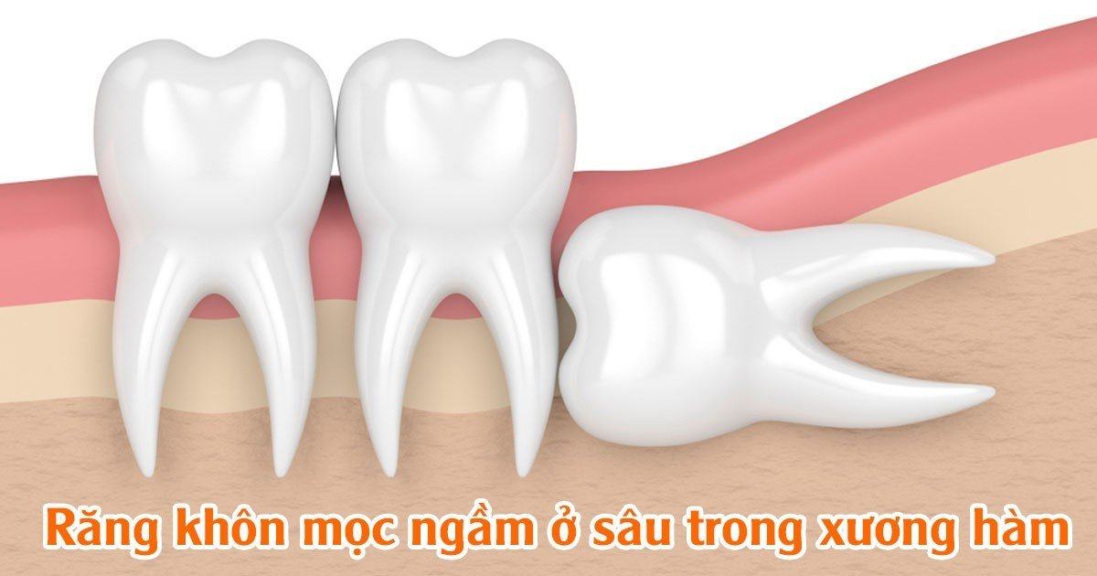 Răng khôn mọc ngầm ở sâu trong xương hàm