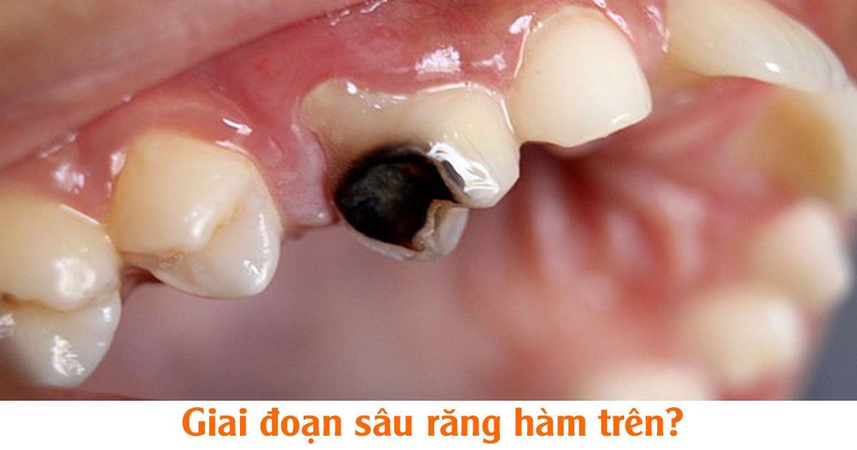 Giai đoạn sâu răng hàm trên?