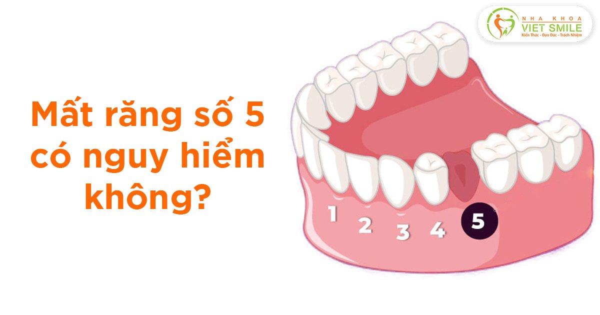 Mất răng số 5 có nguy hiểm không?