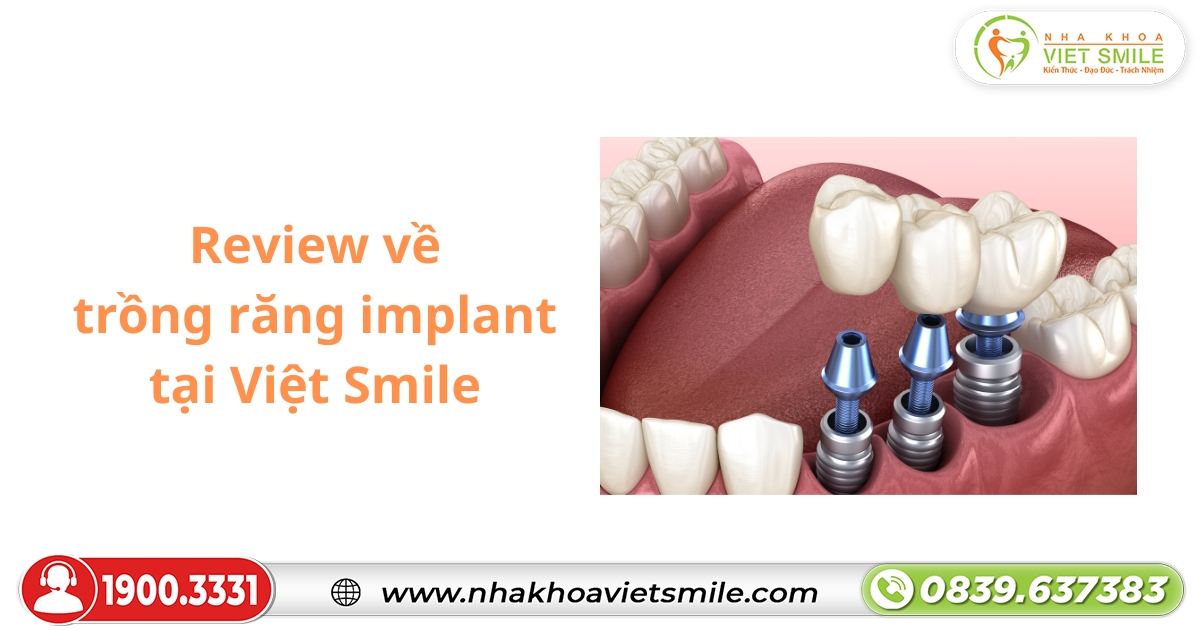 Review về trồng răng implant