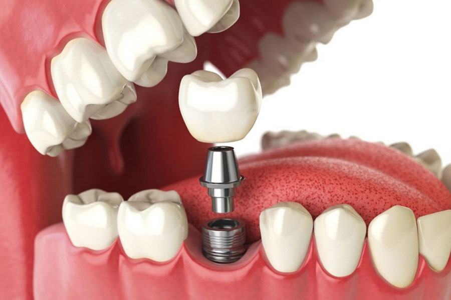 Trồng răng implant cho răng hàm