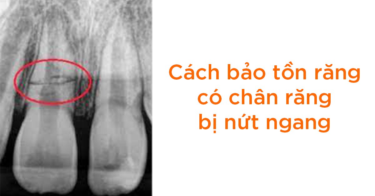 Cách bảo tồn răng có chân răng bị nứt ngang