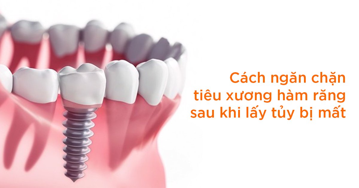 Cách ngăn chặn tiêu xương hàm răng bị mất sau khi lấy tủy