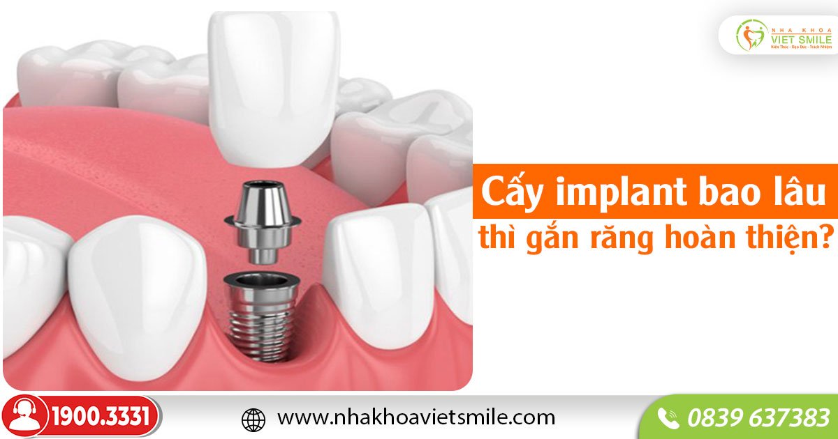 Cấy implant bao lâu thì gắn răng hoàn thiện?