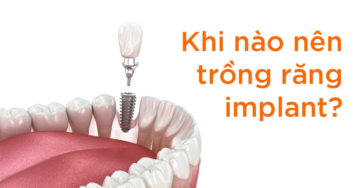 Khi nào nên trồng răng implant?