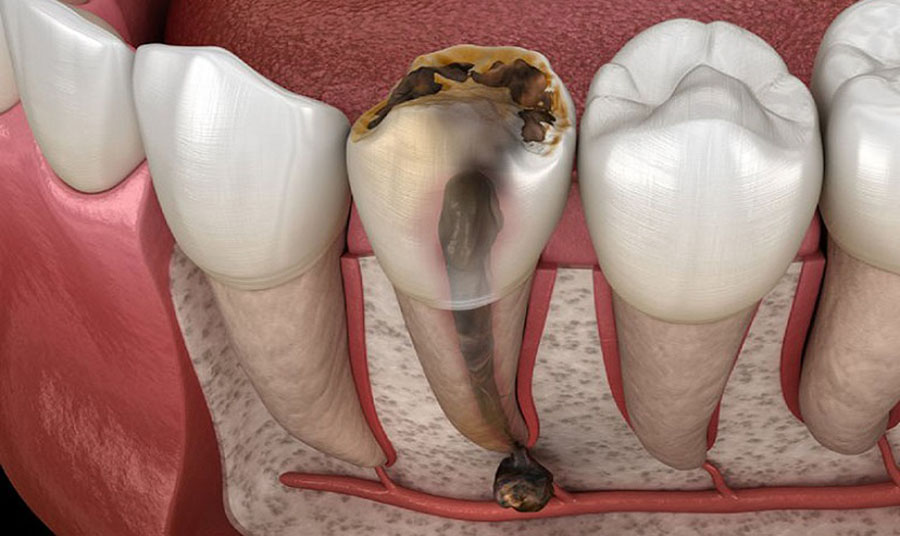 Răng 6 đã bị viêm tủy