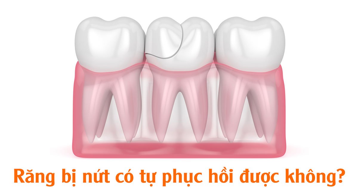 Răng bị nứt có tự phục hồi được không?