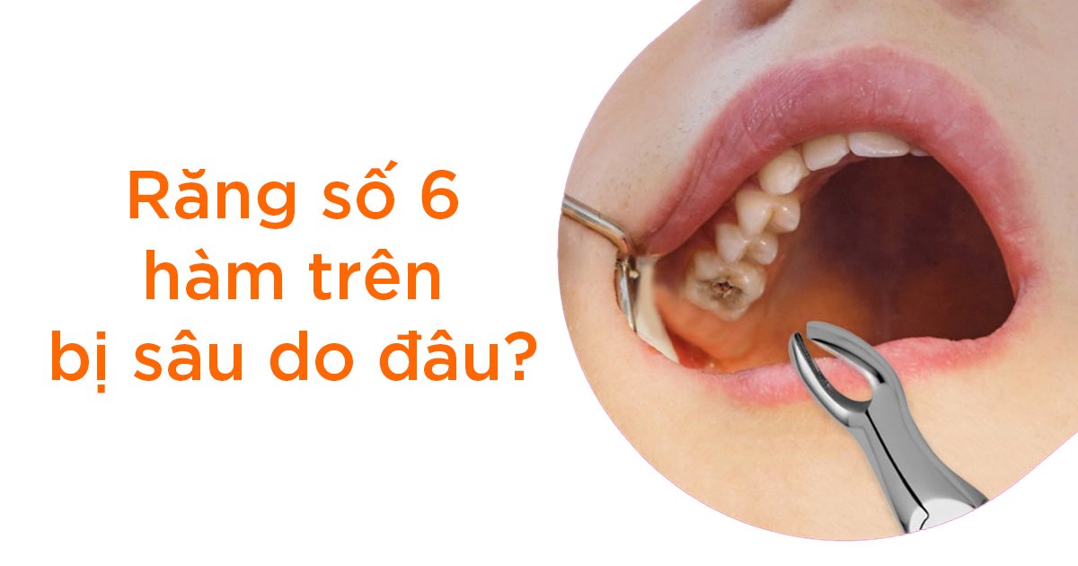 Răng số 6 hàm trên bị sâu do đâu?