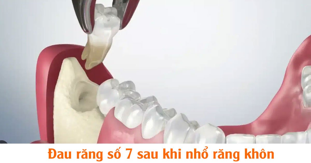 Đau răng số 7 sau khi nhổ răng khôn