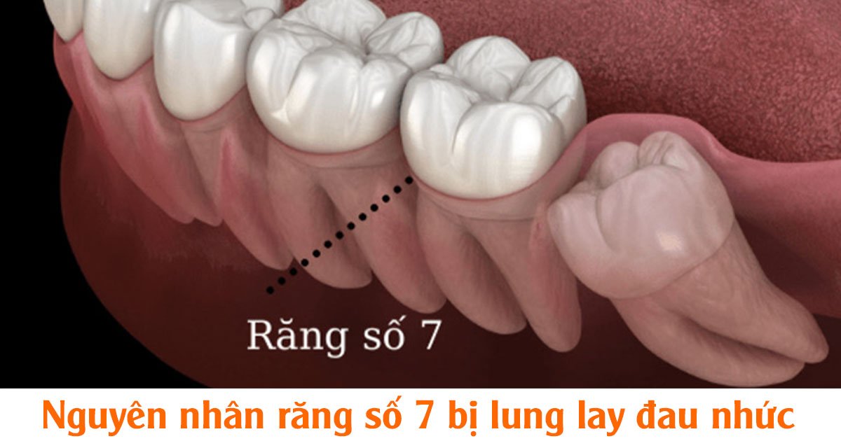 Nguyên nhân răng số 7 bị lung lay đau nhức