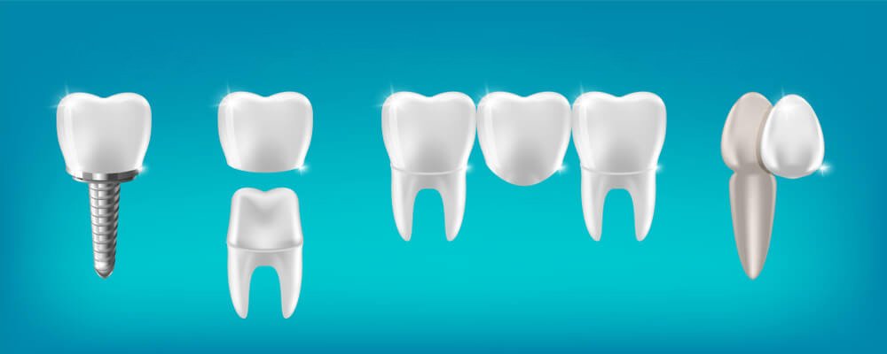 Có những loại phục hình răng cố định nào?