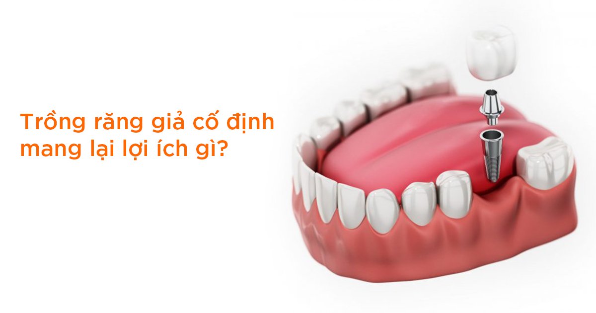 Trồng răng giả cố định mang lại lợi ích gì?