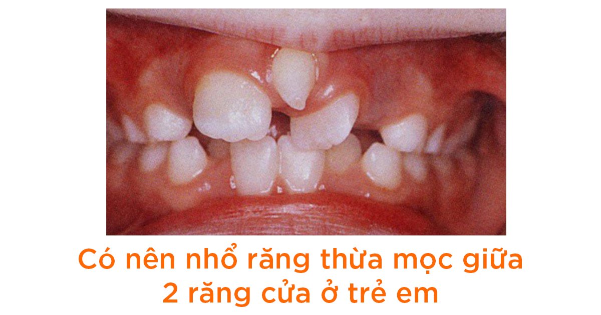 Có nên nhổ răng thừa mọc giữa 2 răng cửa ở trẻ em?