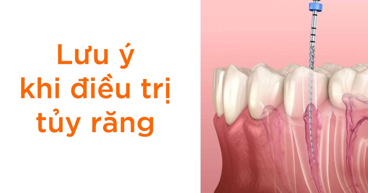 Lưu ý khi điều trị tủy răng