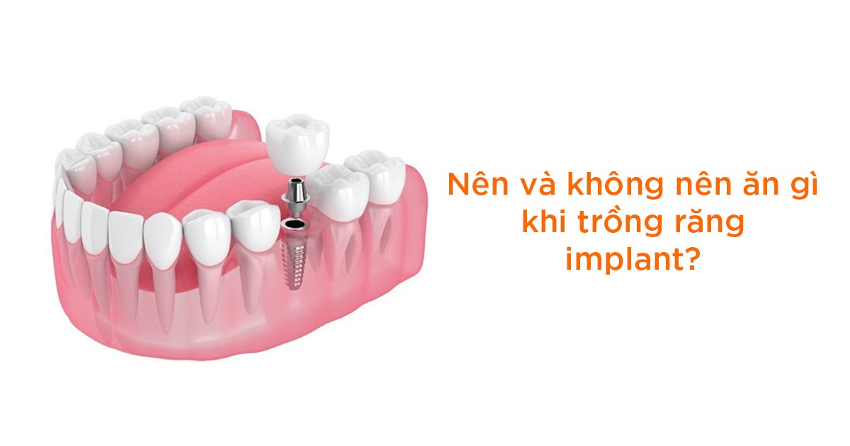 Nên và không nên ăn gì sau khi trồng răng implant