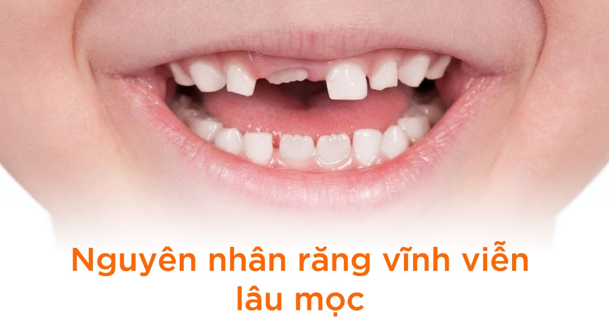 Nguyên nhân răng vĩnh viễn lâu mọc